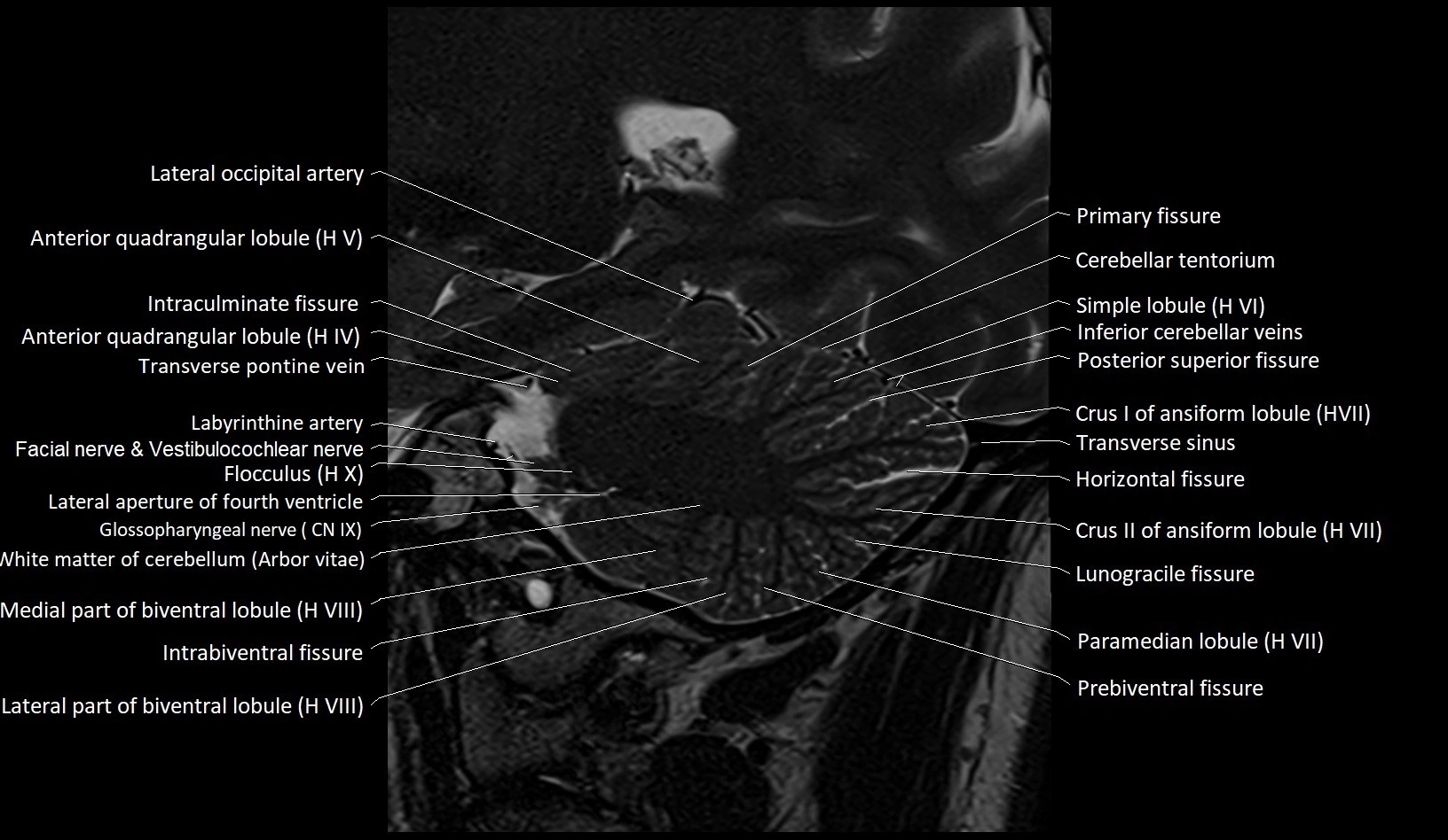 MRI Cerebellar anatomy sagittal High-resolution labelled image 19.webp
